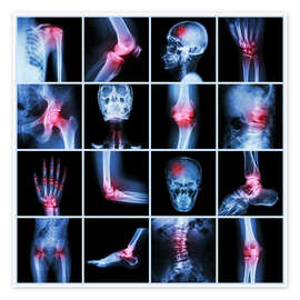 Plakat  Human joint, arthritis and stroke